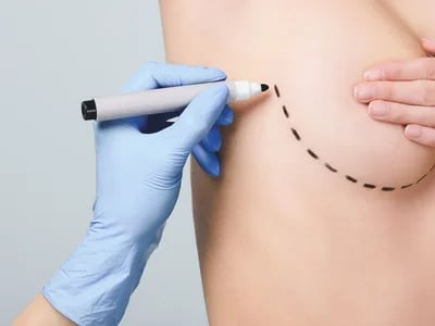 Brustvergrößerung mit Eigenfett: Der Ablauf von der Fettabsaugung bis zur Volumengewinnung